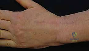 صورة توضيحية لـ زراعة مفصل الرسغ الصناعي: حلول متطورة لآلام الرسغ المزمنة في صنعاء مع الأستاذ الدكتور محمد هطيف