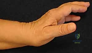 صورة توضيحية لـ زراعة مفصل الرسغ الصناعي: حلول متطورة لآلام الرسغ المزمنة في صنعاء مع الأستاذ الدكتور محمد هطيف