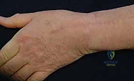 صورة طبية: زراعة مفصل الرسغ الصناعي: حلول متطورة لآلام الرسغ المزمنة في صنعاء مع الأستاذ الدكتور محمد هطيف