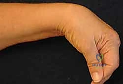 صورة توضيحية لـ زراعة مفصل الرسغ الصناعي: حلول متطورة لآلام الرسغ المزمنة في صنعاء مع الأستاذ الدكتور محمد هطيف