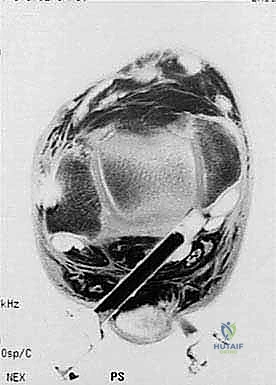 إدخال المنظار والأدوات الجراحية الدقيقة