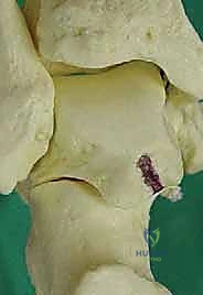 التهاب الأنسجة الرخوة في الكاحل الخلفي