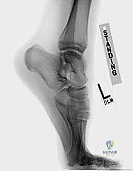 التصوير بالرنين المغناطيسي لتشخيص انحشار الكاحل