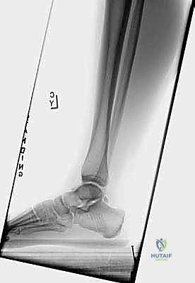 صورة توضح العظمة المثلثية وانحشارها في الكاحل