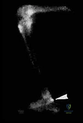 انحشار الكاحل الخلفي: الدليل الشامل لاستئصال السبب بالمنظار مع الأستاذ الدكتور محمد هطيف في صنعاء