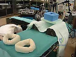 استئصال العظمة المسببة للانحشار بالمنظار