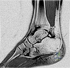 الفحص السريري لتشخيص آلام الكاحل الخلفي