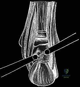 مقارنة بين المنظار الجراحي والجراحة المفتوحة