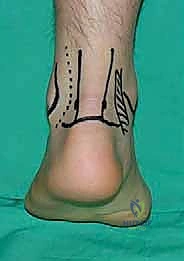 تأثير الرياضة العنيفة على مفصل الكاحل الخلفي