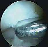 تحديد مواقع الثقوب الجراحية بدقة عالية