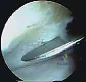 صورة طبية: انحشار الكاحل الخلفي: الدليل الشامل لاستئصال السبب بالمنظار مع الأستاذ الدكتور محمد هطيف في صنعاء