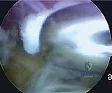 إغلاق الجروح الصغيرة بعد العملية الجراحية