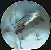 مرحلة التأهيل الأولى واستخدام الحذاء الطبي