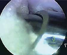 صورة توضيحية لـ انحشار الكاحل الخلفي: الدليل الشامل لاستئصال السبب بالمنظار مع الأستاذ الدكتور محمد هطيف في صنعاء