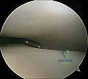 صورة توضيحية لـ انحشار الكاحل الخلفي: الدليل الشامل لاستئصال السبب بالمنظار مع الأستاذ الدكتور محمد هطيف في صنعاء