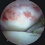 Endoscopic Resection of Posterior Ankle Impingement: An Intraoperative Masterclass