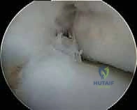 العلاج الطبيعي والتأهيل للكاحل قبل الجراحة