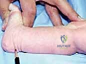 التحضير لجراحة التحرير الخلفي الإنسي