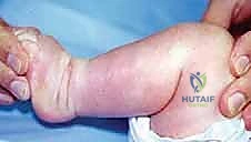 خطوات جراحة القدم الحنفاء بالتفصيل