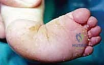 قصص نجاح علاج القدم الحنفاء في اليمن