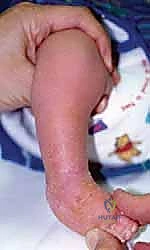 تشخيص القدم الحنفاء بالأشعة السينية