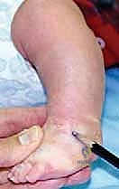 تطويل الأوتار في جراحة القدم الحنفاء