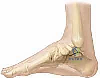 دواعي التدخل الجراحي لتصحيح القدم