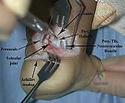 أسباب وعوامل خطر الإصابة بالقدم المخلبية