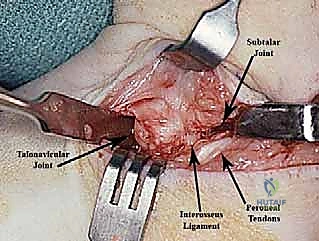 الجبس بعد العمل الجراحي للقدم الحنفاء