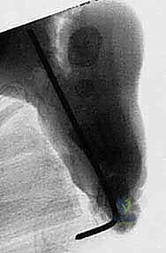 برنامج إعادة التأهيل بعد جراحة القدم