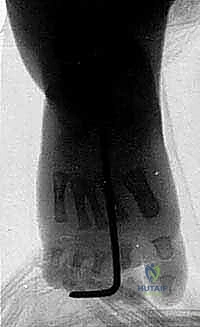 Illustration of posteromedial and posterolateral - Dr. Mohammed Hutaif