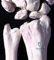 Distal Ulnar Resection Arthroplasty (Darrach Procedure): An Intraoperative Masterclass