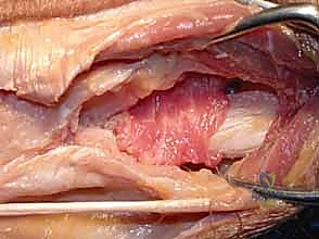 صورة توضيحية لـ جراحة داراتش (استئصال الزند البعيد): حل دائم لآلام مفصل الرسغ المزمنة في صنعاء مع الأستاذ الدكتور محمد هطيف