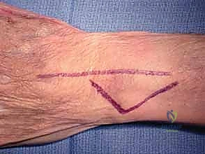 تفاصيل الغضروف الليفي الثلاثي والأربطة