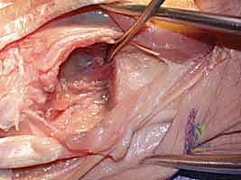 صورة توضيحية لـ جراحة داراتش (استئصال الزند البعيد): حل دائم لآلام مفصل الرسغ المزمنة في صنعاء مع الأستاذ الدكتور محمد هطيف