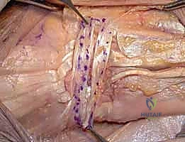 التحضير الجراحي وتحديد مسار الشق في جراحة داراتش