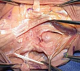 صورة توضيحية لـ جراحة داراتش (استئصال الزند البعيد): حل دائم لآلام مفصل الرسغ المزمنة في صنعاء مع الأستاذ الدكتور محمد هطيف