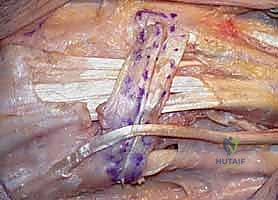 تثبيت الأنسجة الرخوة لمنع عدم استقرار الزند المتبقي