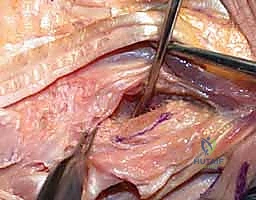 إجراء القطع العظمي (Osteotomy) لاستئصال رأس الزند