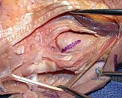 استخراج الجزء المستأصل من عظم الزند