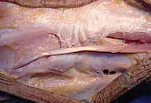 الوصول الجراحي لعظم الزند البعيد