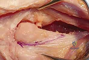 صورة توضيحية لـ جراحة داراتش (استئصال الزند البعيد): حل دائم لآلام مفصل الرسغ المزمنة في صنعاء مع الأستاذ الدكتور محمد هطيف