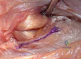 جراحة داراتش (استئصال الزند البعيد): حل دائم لآلام مفصل الرسغ المزمنة في صنعاء مع الأستاذ الدكتور محمد هطيف