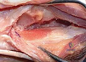 صورة توضيحية لـ جراحة داراتش (استئصال الزند البعيد): حل دائم لآلام مفصل الرسغ المزمنة في صنعاء مع الأستاذ الدكتور محمد هطيف