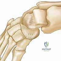 فحص وتقييم القدم الحنفاء المقاومة