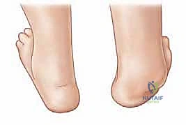 تحرير وعزل وتر الظنبوب الأمامي