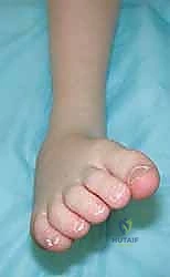 نقل وتر الظنبوب الأمامي إلى العظم الإسفيني الوحشي حل متقدم للقدم الحنفاء المقاومة