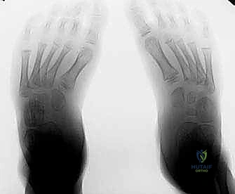 صورة توضيحية لـ نقل وتر الظنبوب الأمامي إلى العظم الإسفيني الوحشي حل متقدم للقدم الحنفاء المقاومة