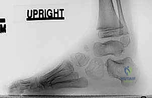 صورة توضيحية لـ نقل وتر الظنبوب الأمامي إلى العظم الإسفيني الوحشي حل متقدم للقدم الحنفاء المقاومة