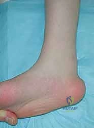 صورة توضيحية لـ نقل وتر الظنبوب الأمامي إلى العظم الإسفيني الوحشي حل متقدم للقدم الحنفاء المقاومة